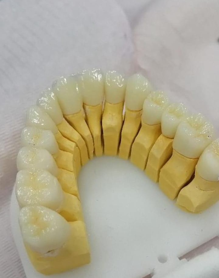 Diş Laboratuvarında Zirkonyum Kron Hazırlığı